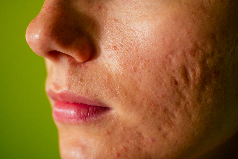 Littekens door acne