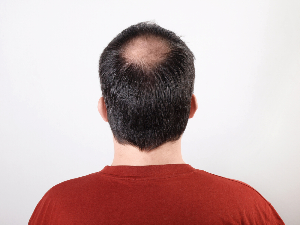 Alopecia diffusa